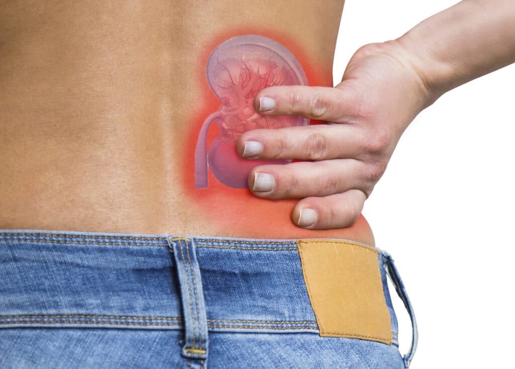 Kidney Stones