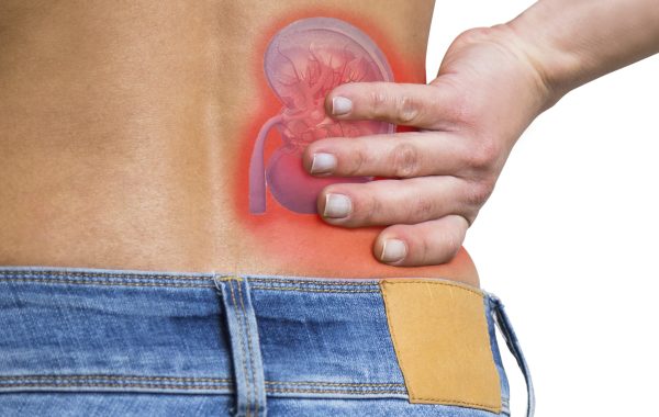 Kidney Stones
